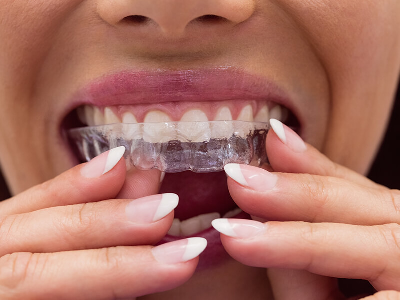 alinhadores invisíveis