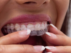 alinhadores invisíveis